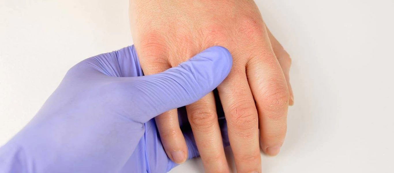 Δερματίτιδα: Αυτοί είναι οι 4 τρόποι για να ανακουφιστείτε από τη φαγούρα